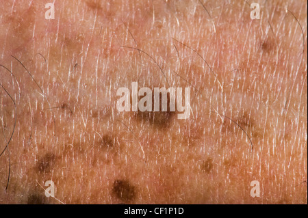 Altersflecken vor Ort Haut alte Problem Krebs entdeckt Nahaufnahme Closeup Makro Makro Dot braun kupferbraun alte Mann Gefahr gefährlich Stockfoto