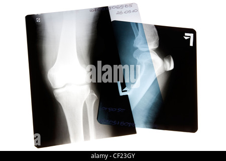 Das Bein und Knie geröntgt Stockfoto