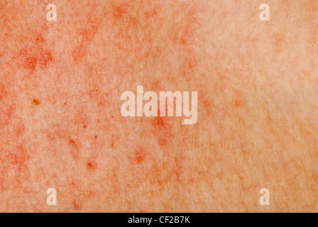 allergische Dermatitis Hautausschlag Hautbeschaffenheit des Patienten Stockfoto