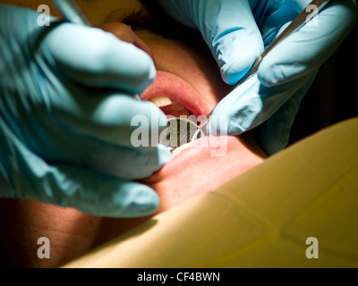 Ein Zahnarzt überprüft die Rückseiten der Zähne eines Patienten in seinem Büro. Nahaufnahme der die Hände des Arztes hält einen Spiegel und Sonde Stockfoto