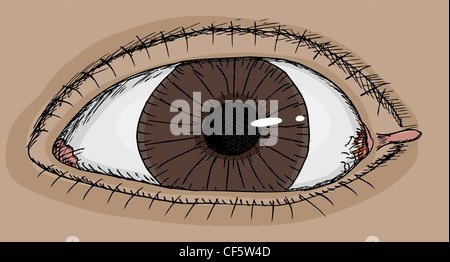 Nahaufnahme des menschlichen Auges mit Fibrom in Ecke Stockfoto