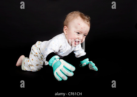 kleiner Junge mit Windpocken Stockfoto