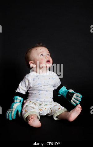 Junge mit Windpocken Stockfoto