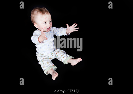 kleiner Junge mit Windpocken Stockfoto