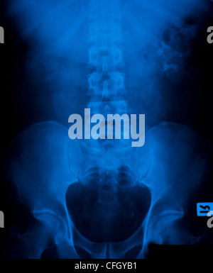 X-ray Film aus Stein in der Blase. Stockfoto