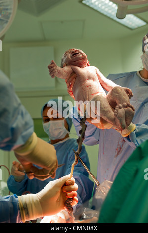 Die Geburt von einem kaukasischen Babymädchen in einem Krankenhaus Operationssaal nach einem Kaiserschnitt Nabelschnur verbunden Stockfoto