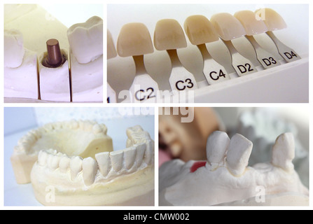 Zahntechniker-Collage mit Gips Mund, Implantat-Abutment und dental Farbschlüssel Stockfoto