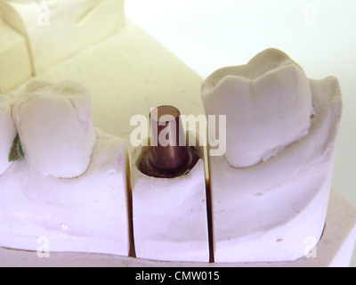 Metallischen Implantat-Abutment auf weiße Zähne Gipsmodell für Zahntechniker Stockfoto