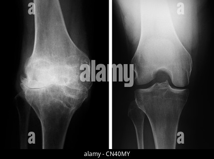 Röntgenstrahlen zeigen ein Knie mit schweren degenerativen Veränderungen (links) und den Verlust des gemeinsamen Raumes mit einem normalen Knie (rechts) Stockfoto