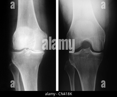 Röntgenstrahlen zeigen ein Knie mit schweren degenerativen Veränderungen (links) und den Verlust des gemeinsamen Raumes mit einem normalen Knie (rechts) Stockfoto