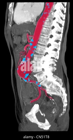 CT-Scan-Bilder zeigen einen abdominalen Aortenaneurysma Stockfoto