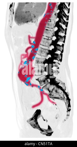 CT-Scan-Bilder zeigen einen abdominalen Aortenaneurysma Stockfoto