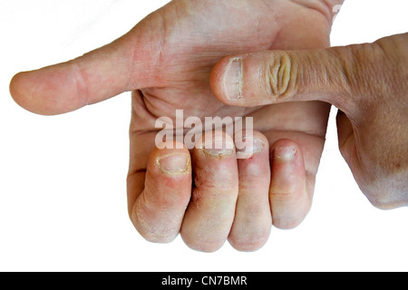 Hände mit gebissen Nägel Stockfoto