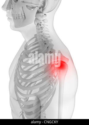 Schulter Schmerzen konzeptuellen Kunstwerk Stockfoto