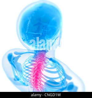 Schmerzen im Rücken konzeptuellen Kunstwerk Stockfoto