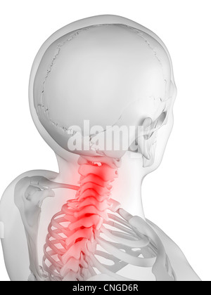 Nacken Schmerzen konzeptuellen Kunstwerk Stockfoto