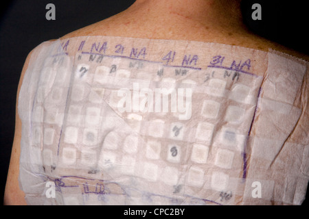 Rücken des Patienten eine Frau ist mit den Patches von einem Chemotechnique Allergan Serie bestimmte allergische Reaktionen bestimmen bedeckt. Stockfoto