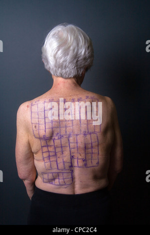 Rücken des Patienten eine Frau wird mit Angabe der Standorte für die Patches einer Chemotechnique Allergan Reihe Quadrate gezeichnet. Stockfoto