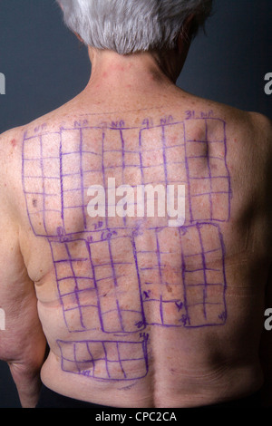 Rücken des Patienten eine Frau wird mit Angabe der Standorte für die Patches einer Chemotechnique Allergan Reihe Quadrate gezeichnet. Stockfoto