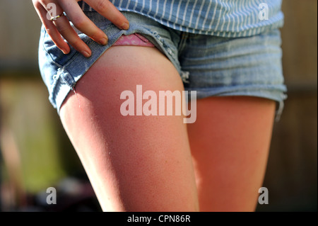 Junge Frau zeigt Sonnenbrand auf ihren Beinen nach der Hitzeperiode des Wetters im Vereinigten Königreich in den letzten Wochen Mai 2012 Stockfoto