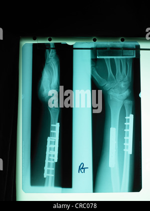 X-ray auf einem Leuchtkasten Stockfoto