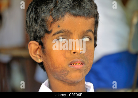 Mädchen, geblendet durch eine Infektion, Schule für Blinde, Tangalle, Sri Lanka, Ceylon, Südasien, Asien Stockfoto