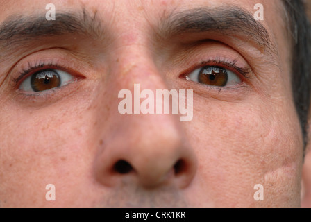 Gesichts Narbe auf dem linken Scheck ein 30 Jahre alter Mann. Die Narbe wurde verursacht, während die Heilung einer Wunde. Stockfoto