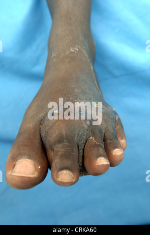 Myzetom Progressive entzündliche Diseas Soft Tissue Granuloma