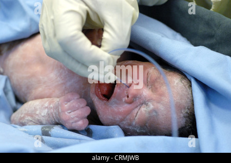 Eine behandschuhte Hand legen eine kleine Absaugung in den Mund eines neugeborenen Babys, um unerwünschte Schleim zu entfernen. Stockfoto