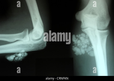 XRAY des Knies mit einem großen Wachstum Stockfoto