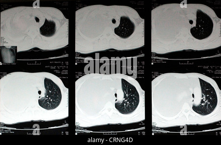 Ein CT-Scan zeigt einen schweren Haemothroax auf der rechten Seite der Brust des Patienten. Stockfoto