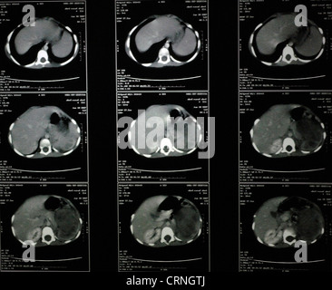 Cat-Scan von einem Menschen Brust Stockfoto