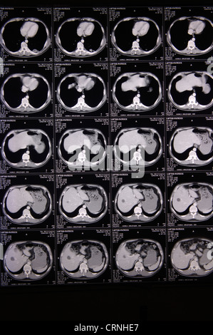 Die MRI Scans gemacht auf der Großhirnrinde. Stockfoto