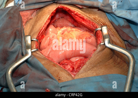 Der Chirurg operieren auf einer Dickdarm. Stockfoto