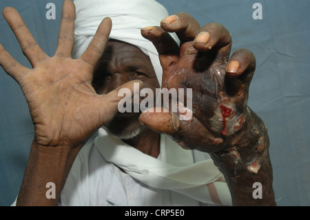 Vergleich zwischen normalen rechten und linken Hand mit Eumycetoma. Stockfoto