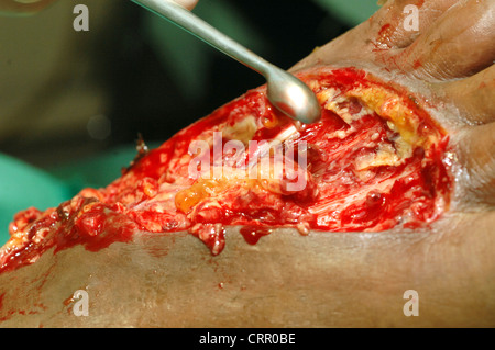 Operation auf einem Fuß mit Zerfall der Zelle. Stockfoto