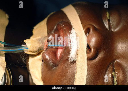 Ein junges Kind bald nach einer Operation auf dem OP-Tisch legen, eine Lippenspalte zu reparieren. Stockfoto