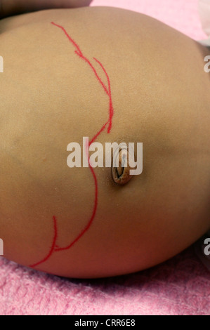 Ein Chirurg auf ein kleines Kind erwartet Chirurgie gezeichneten Linie. Stockfoto