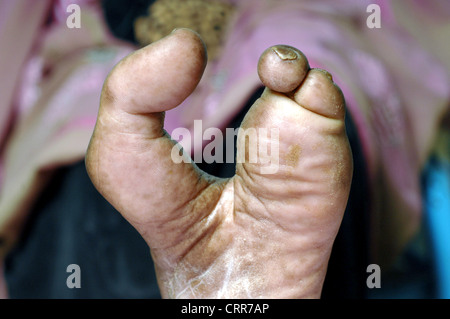 Nahaufnahme eines linken Fußes mit zweiten, dritten und vierten Zehen amputiert werden. Stockfoto