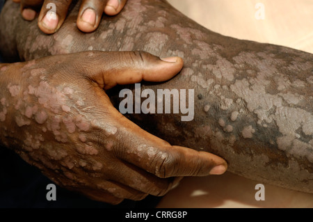 Ein Patient mit schweren, umfangreiche Psoriasis überall auf ihrem Körper. Stockfoto