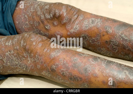 Ein Patient mit schweren, umfangreiche Psoriasis überall auf ihrem Körper. Stockfoto