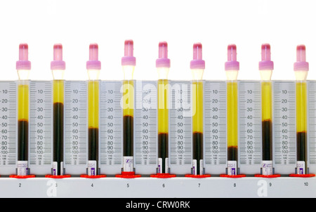 Erythrozyten Sedimentation Rate, Blut in die Sedivetten Senkungsstaender Stockfoto