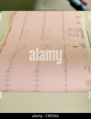 Eine Elektrokardiogramm Aufnahme eines Patienten kardiale Zyklus produziert durch ein EKG Stockfoto