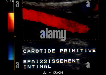 ARTERIELLE STENOSE, SONOGRAPHIE Stockfoto