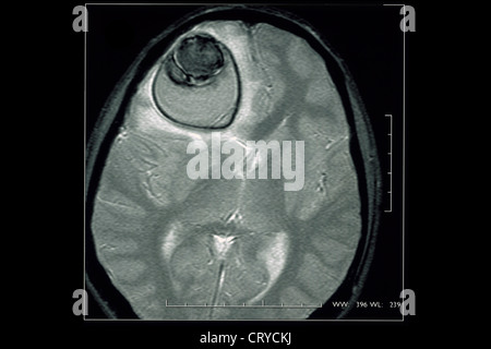 ZYSTE IM GEHIRN, MRT Stockfoto