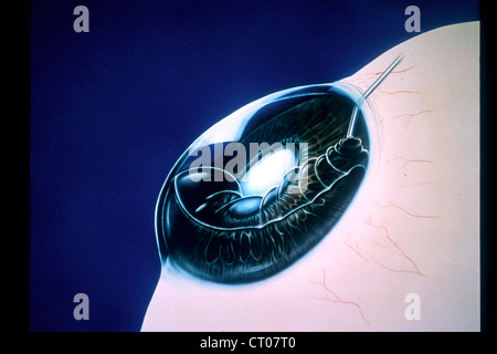 Hornhauttransplantation, Zeichnung Stockfoto