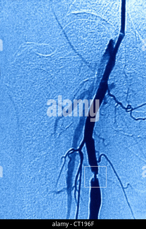 STENOSE, FEMORAL ARTERIE, ANGIO. Stockfoto