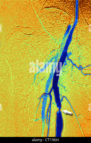 STENOSE, FEMORAL ARTERIE, ANGIO. Stockfoto