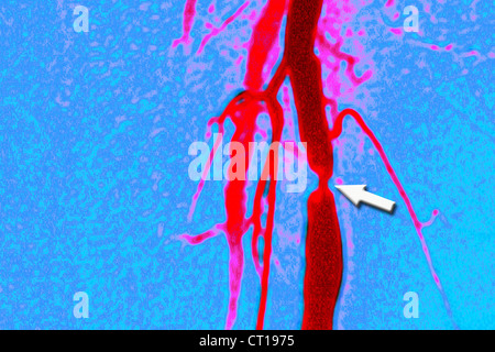 STENOSE, FEMORAL ARTERIE, ANGIO. Stockfoto