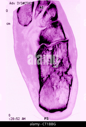 SPRUNGGELENK ARTHROSE, MRT Stockfoto